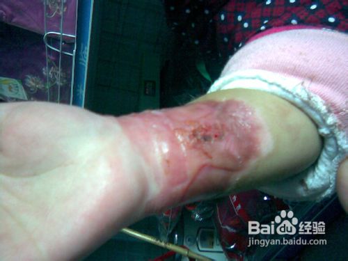 如何去除烫伤疤痕