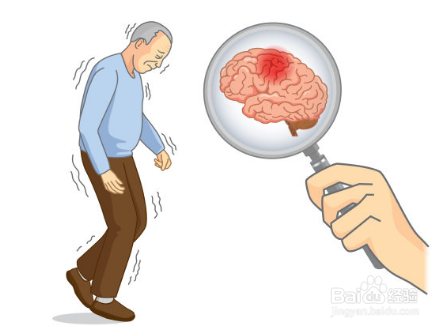 特发性震颤怎么恢复