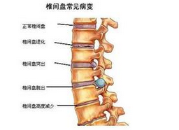青壮年人为啥会得腰间盘突出