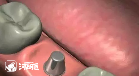 几张图让你看明白种植牙的过程！
