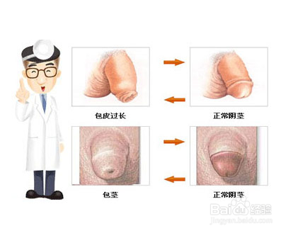 包皮过长怎么办