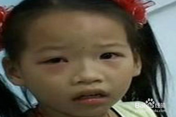 夏季谨防红眼病