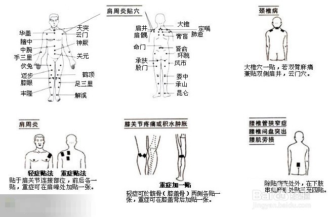肩周炎的治疗方法