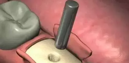 种植牙的过程是怎样的