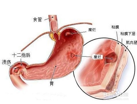 烧心是怎么回事