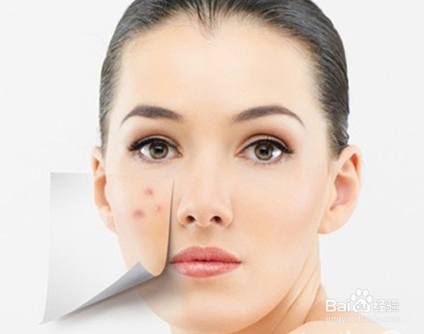 发痤疮了怎么办？