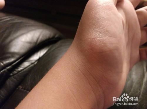 狗咬了肿起来了怎么办