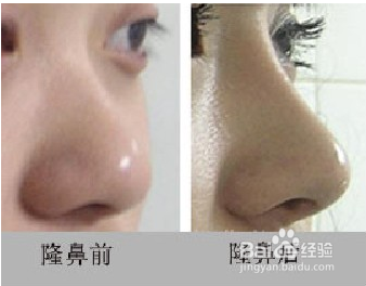 玻尿酸的注射，隆出来的鼻子效果如何你知道么
