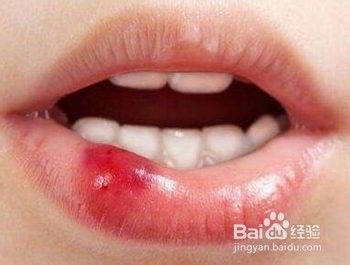 嘴唇疱疹怎么快速消除 百度经验 嘴唇疱疹怎么快速消除 百度经验