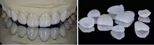 牙齿贴面美白全攻略