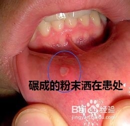 出现口腔溃疡怎么办?