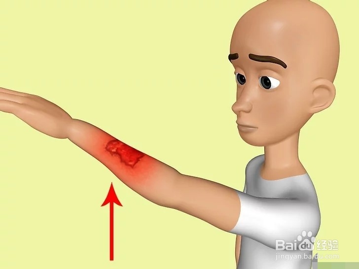 如何治疗烧伤？