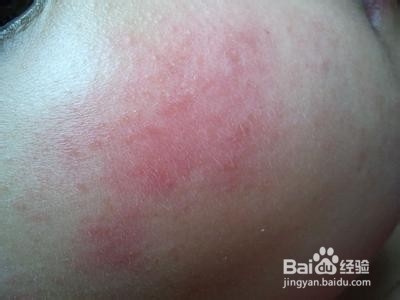 秋冬皮肤病预防——过敏性皮肤病
