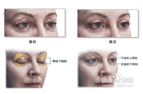 祛眼袋[1]祛眼袋的方法