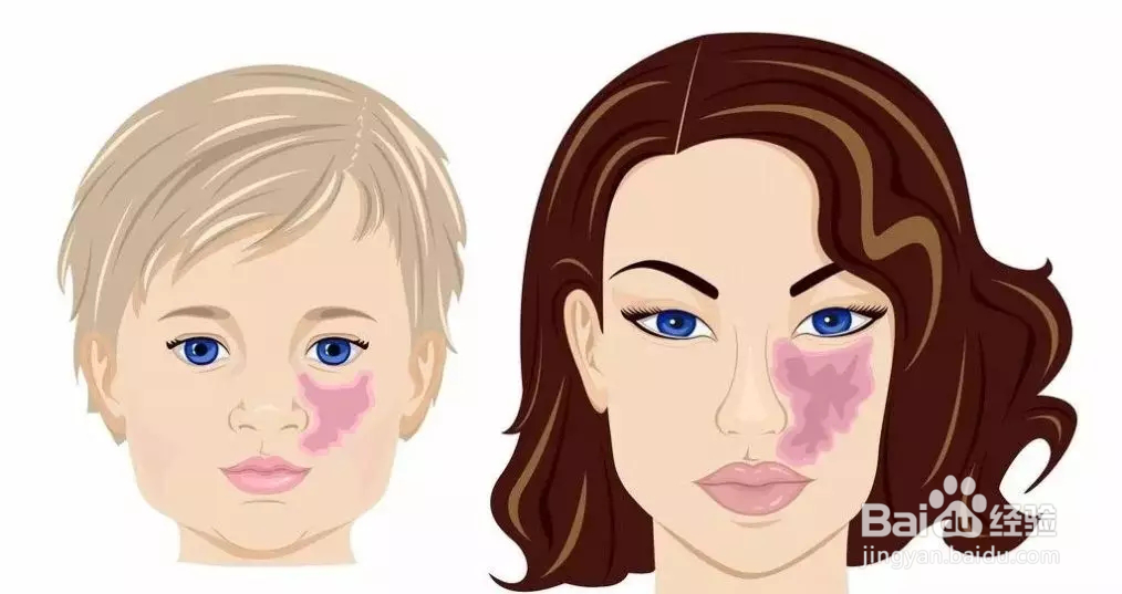 红色胎记可以去掉吗，红胎记哪里治疗？