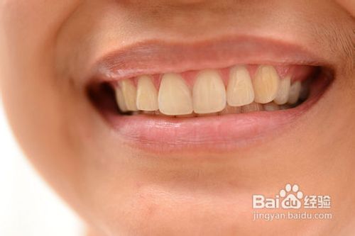 如何获得完美的牙齿