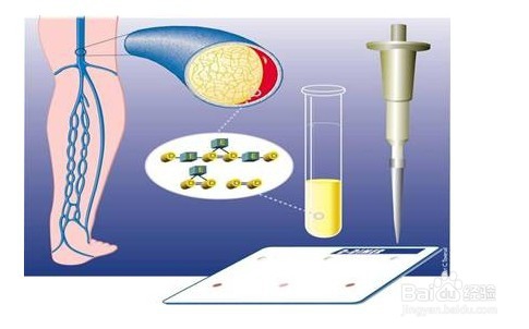 治疗老烂腿的方法