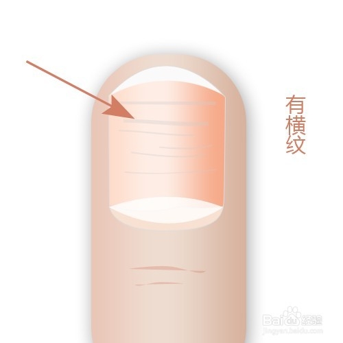 通过指甲看身体状况