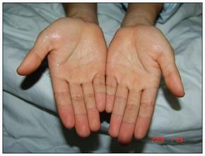 (一)多汗是怎么回事?它是不是病?