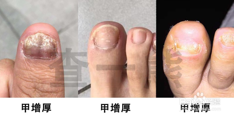 孙叔公灰指甲治疗手册