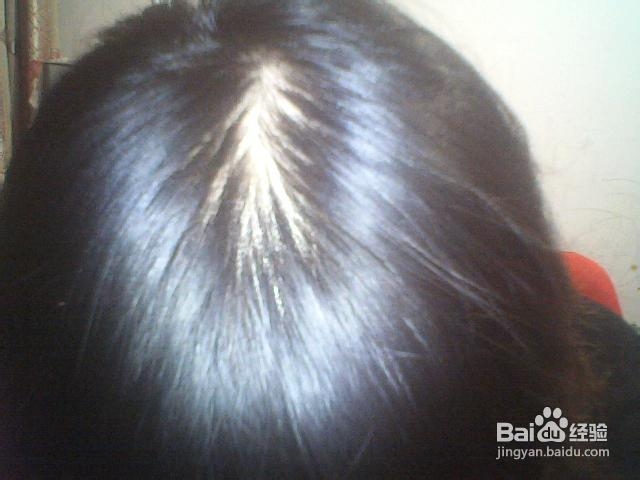 如何治疗脱发