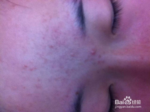 鼻子脱皮怎么办?有什么解决方法?