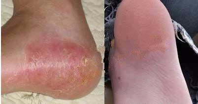 脚部湿疹症状有哪些_最佳治疗方法 【图文】