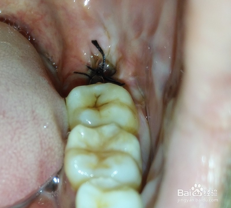 拔牙以后需要注意什么