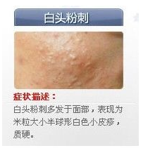 世上最全面治疗痘痘大全