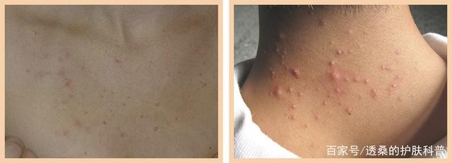 背部起痘怎么去除？