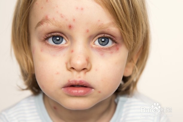 得水痘怎么护理