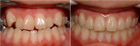 牙齿矫正的方法具体有哪几种