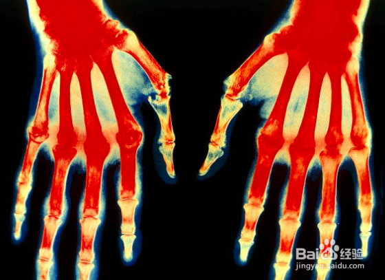 腰肌劳损怎么恢复?得了腰肌劳损怎么办?