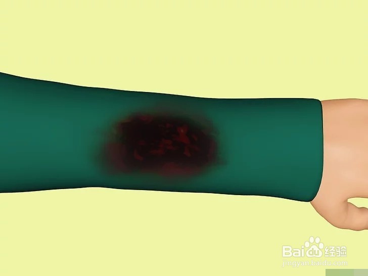 如何治疗烧伤？