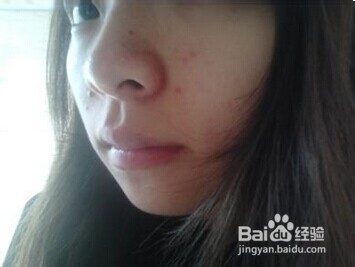 脸上长痘痘究竟为哪般？