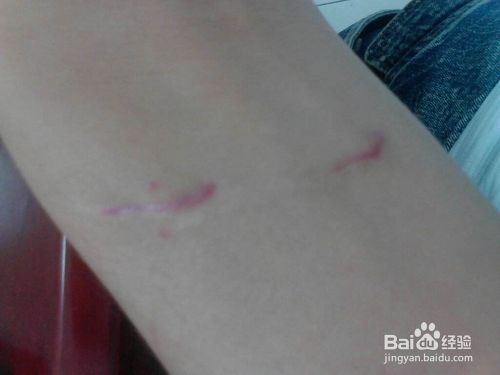 疤痕色素沉着怎么除 百度经验