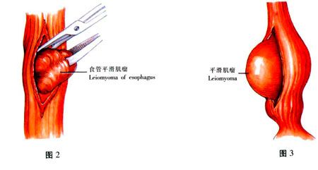 食管平滑肌瘤可诱发哪些症状