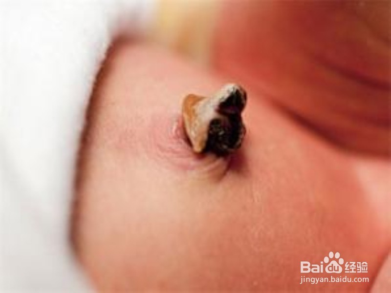 如何护理好宝宝的脐带