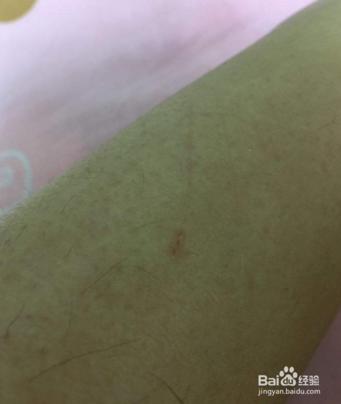 被猫抓伤后该怎么办？