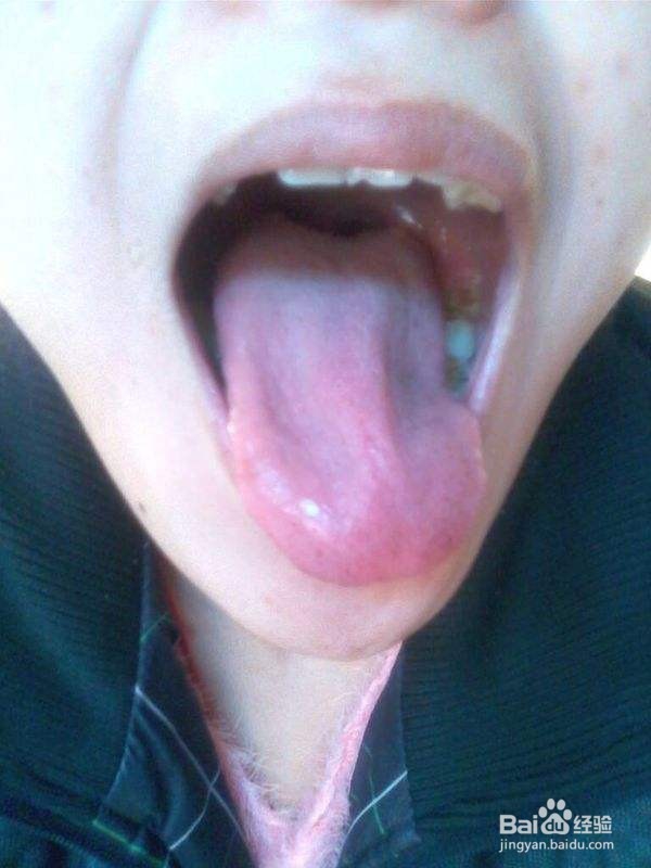 小孩积食咳嗽怎么办？小孩舌苔厚白是怎么回事