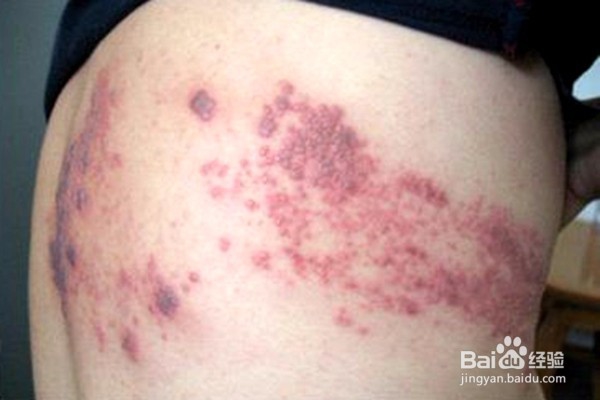 带状疱疹前期症状