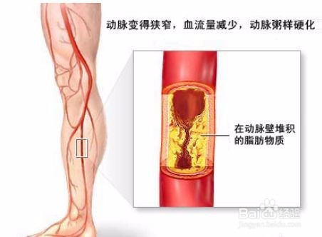 如何自测血管堵没堵，怎样预防血管堵塞