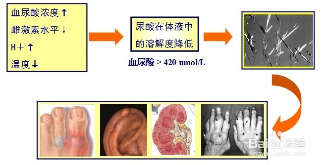 中老年人最易患的关节疾病一痛风。