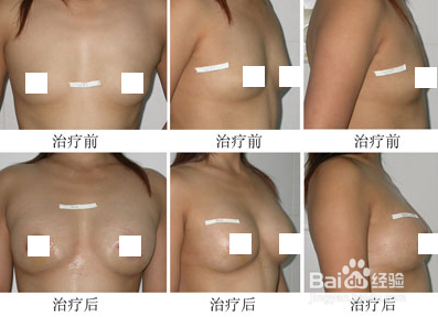 丰胸吃木瓜葛根有用吗