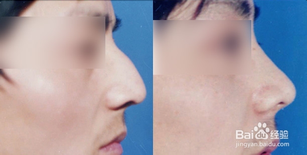 驼峰鼻前后对比照片