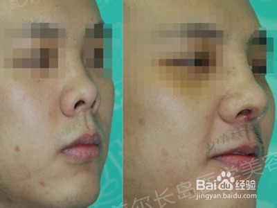 短鼻、朝天鼻 前后对比照片