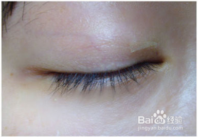 内双变成开眼角双眼皮的技巧
