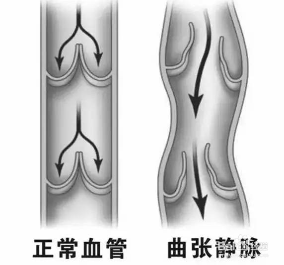 下肢静脉曲张的病因，如何康复治疗