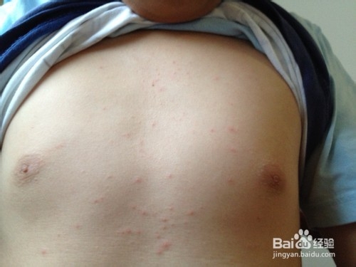 痱子和湿疹的区别