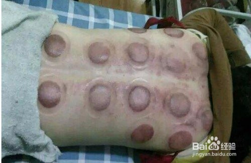 湿气是什么原因?湿气重的症状以及解决办法